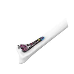 2.4MM AV-WISELOCK DISTAL RADIUS VOLAR RIM
  M PLATE  