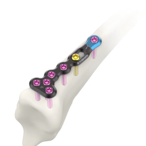 2.4MM AV-WISELOCK T-DISTAL RADIUS SMALL
  FRAGMENT M PLATE  