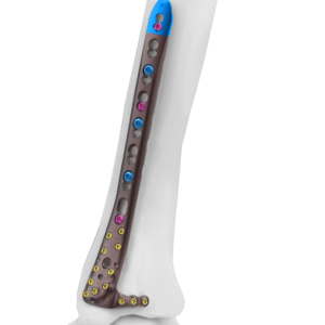 2.7-3.5MM VARIXIS ANTEROMEDIAL DISTAL
  TIBIA PLATE  