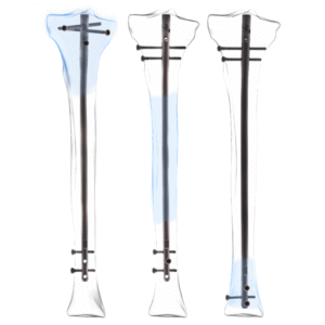 SUPRAPATELLAR TIBIA NAIL  